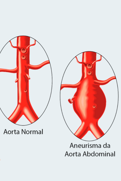 Aneurisma da Aorta Tóraco-Abdominal