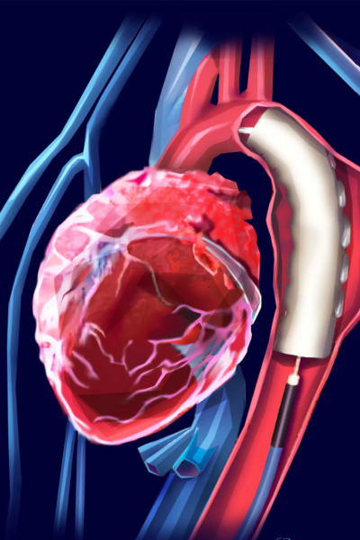 Aneurisma da Aorta Torácica Descendente