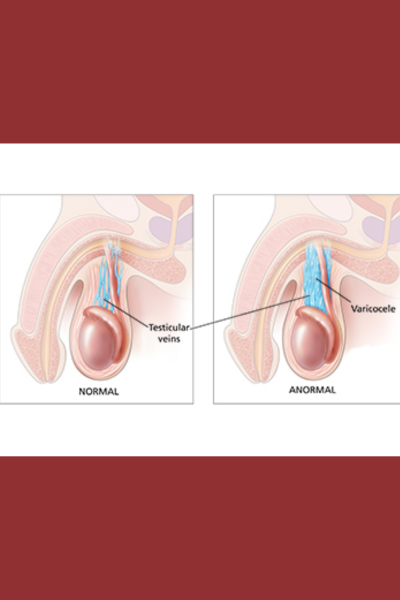 Tratamento Percutâneo da Varicocele